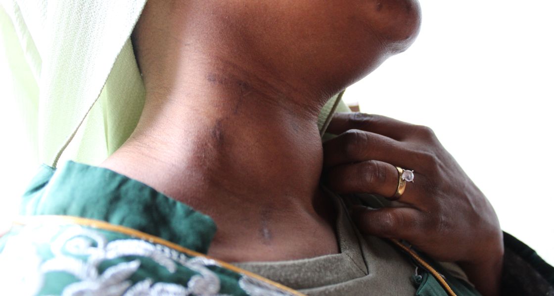 Eine Frau zeigt ihre Narben am Hals.